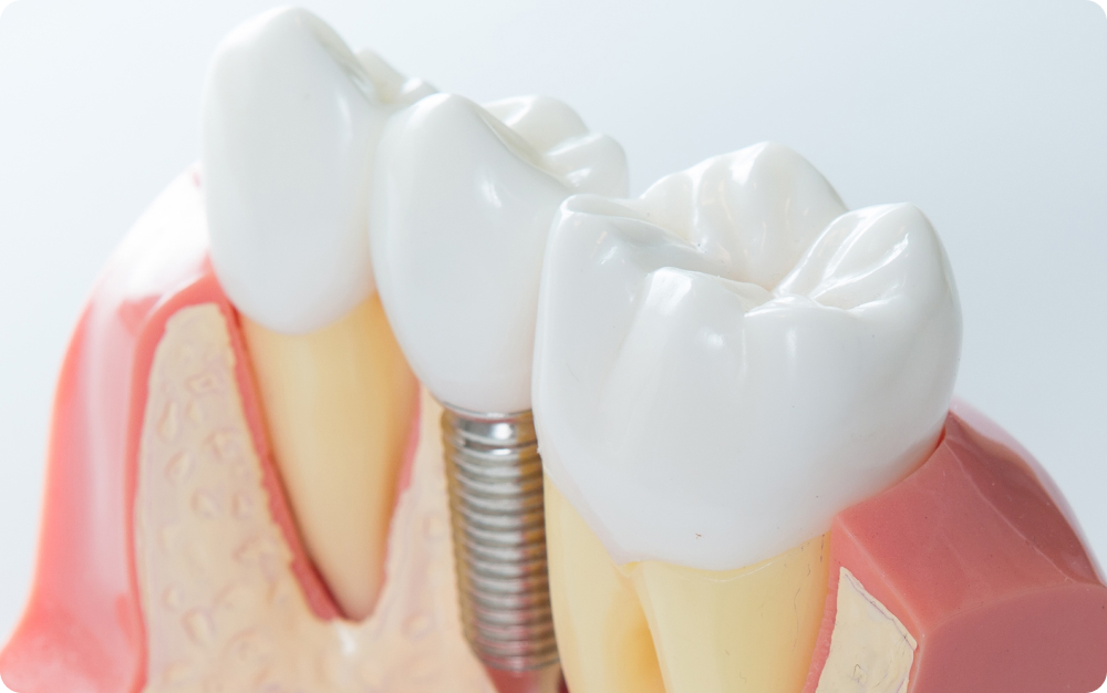 インプラント